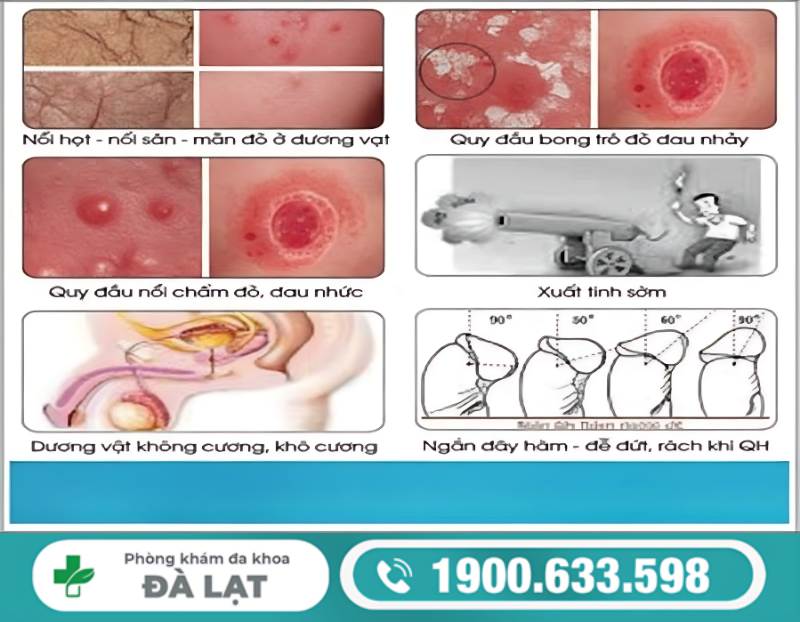 CÁC BỆNH THƯỜNG GẶP Ở LỖ SÁO NAM GIỚI VÀ CÁCH ĐIỀU TRỊ HIỆU QUẢ