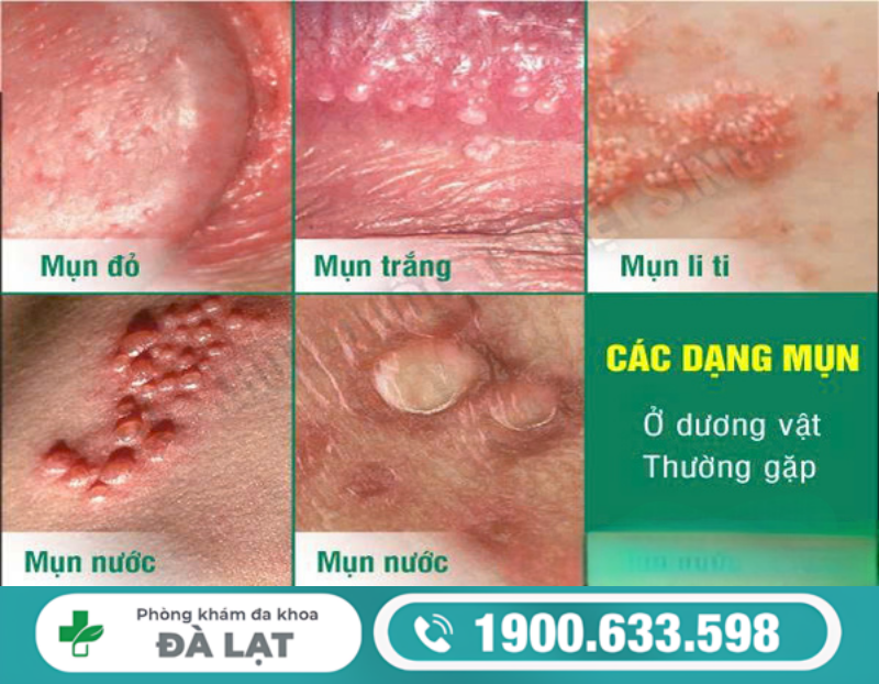 NAM GIỚI MỌC MỤN Ở LỖ SÁO: DẤU HIỆU CẢNH BÁO BÊNH LÝ NGUY HIỂM 