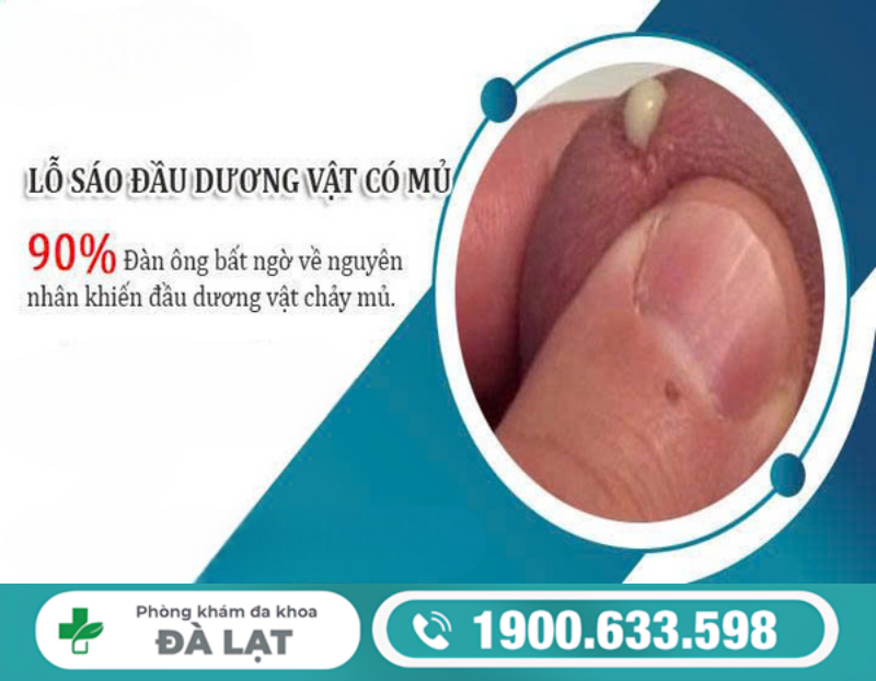LỖ SÁO CHẢY MỦ Ở NAM GIỚI: DẤU HIỆU,NGUYÊN NHÂN VÀ CÁCH ĐIỀU TRỊ 