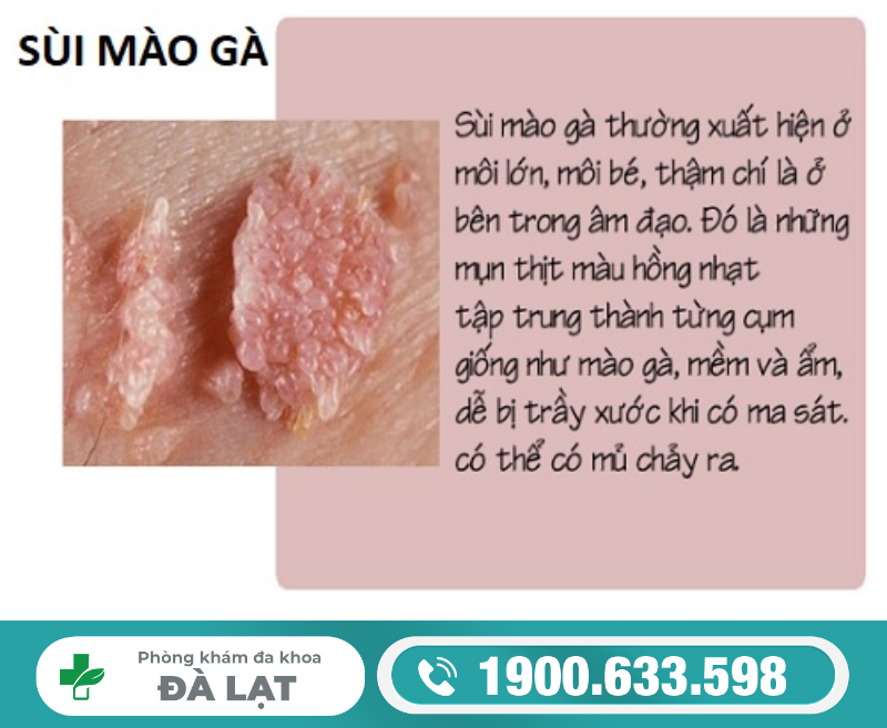 Bệnh sùi mào gà giai đoạn đầu ở nữ giới