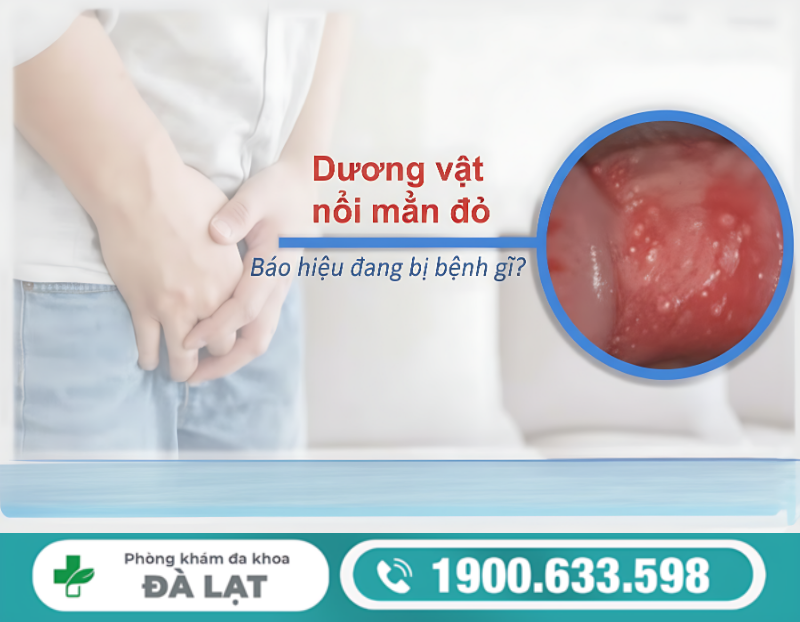 MẨN ĐỎ Ở BỘ PHẬN SINH DỤC NAM: DẤU HIỆU TUYỆT ĐỐI KHÔNG NÊN BỎ QUA