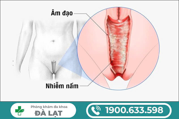 Tìm Hiểu Về: Bệnh Nấm Âm Đạo 