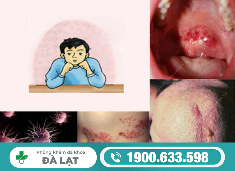 Bao quy đầu chảy mủ có nguy hiểm không ? 