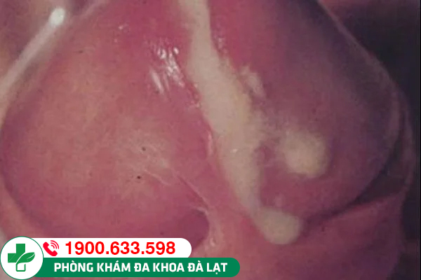 Chảy mủ lỗ sáo có nguy hiểm không ?