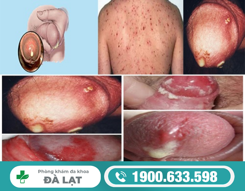 GIỌT MỦ BAN MAI LÀ GÌ