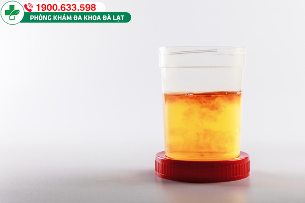 ĐI TIỂU RA DỊCH MÀU VÀNG : NGUYÊN NHÂN , DẤU HIỆU VÀ CÁCH ĐIỀU TRỊ ?