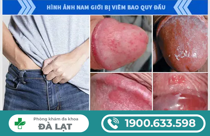 HÌNH ẢNH VIÊM BAO QUY ĐẦU: NHẬN BIẾT CÁC MỨC ĐỘ NHẸ -  NẶNG