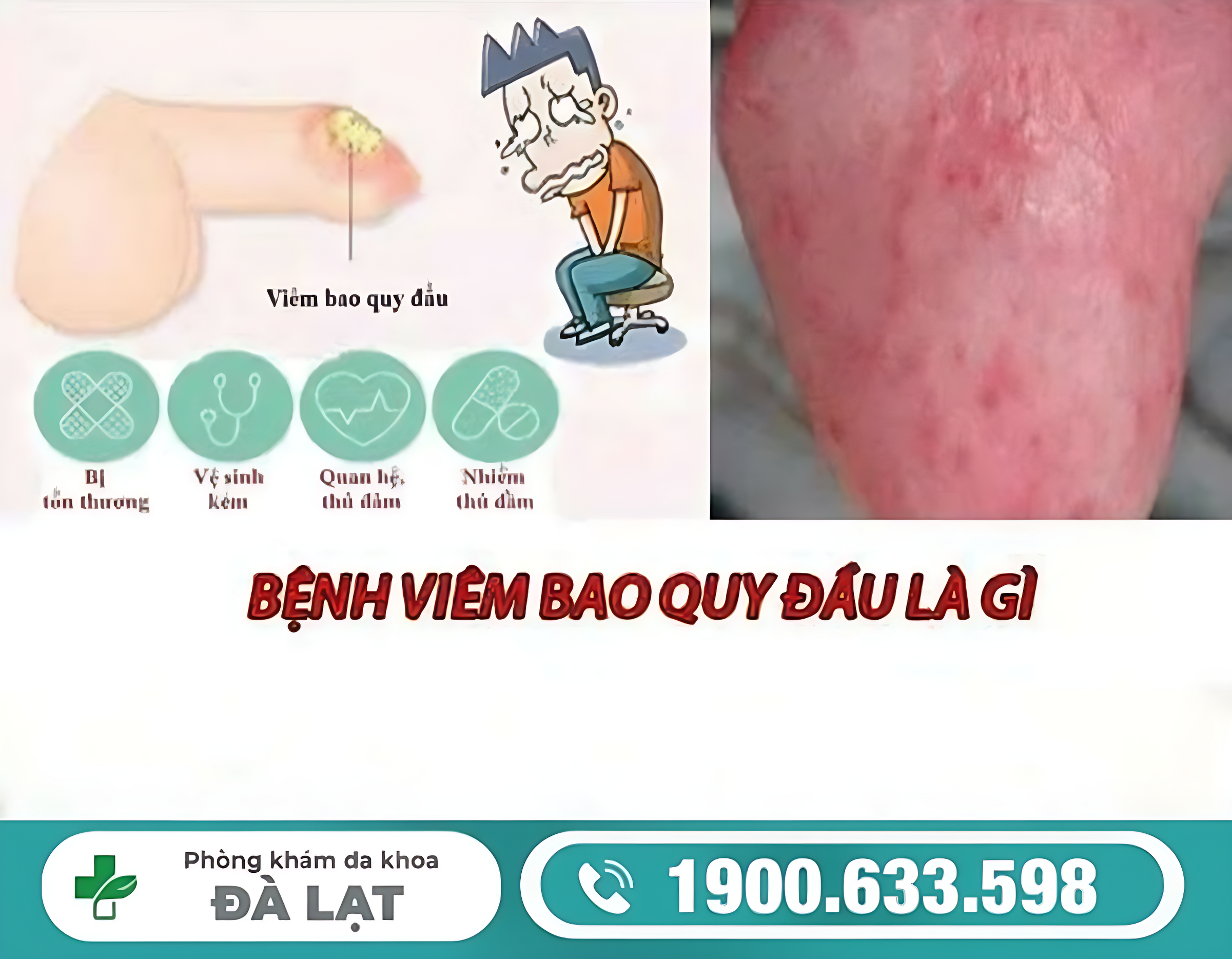 TÌM HIỂU VIÊM BAO QUY ĐẦU Ở NAM GIỚI: NGUYÊN NHÂN, TRIỆU CHỨNG VÀ CÁCH ĐIỀU TRỊ 