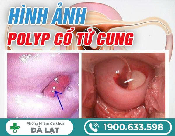 Hình Ảnh Polyp Cổ Tử Cung 
