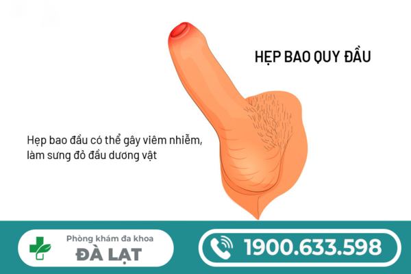 HẸP BAO QUY ĐẦU GÂY RA NHỮNG TÁC HẠI GÌ? SỰ THẬT NAM GIỚI CẦN BIẾT