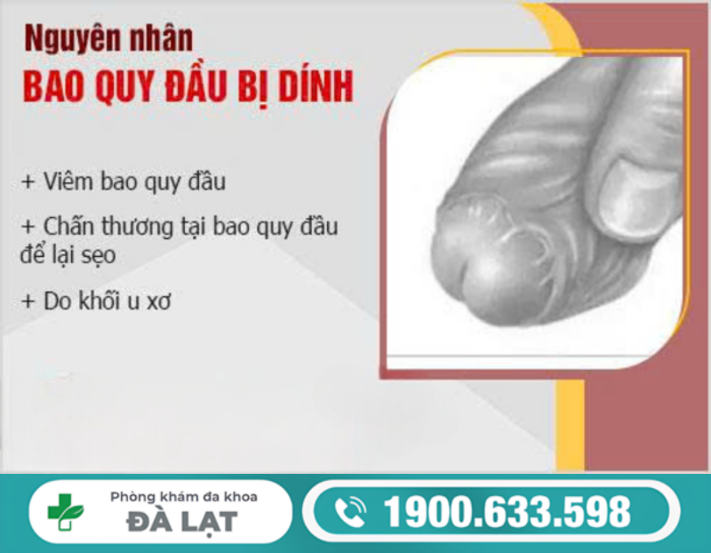 DÍNH BAO QUY ĐẦU Ở NGƯỜI TRƯỞNG THÀNH: NHẬN BIẾT SỚM ĐỂ TRÁNH BIẾN CHỨNG 