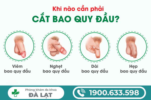 TƯ VẤN CẮT BAO QUY ĐẦU Ở NAM GIỚI: KHI NÀO CẦN THỰC HIỆN ĐỂ TRÁNH BIẾN CHỨNG NGUY HIỂM?