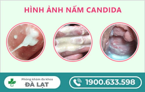 Tìm Hiểu: Nấm Candida Lây Qua Đường Nào? 