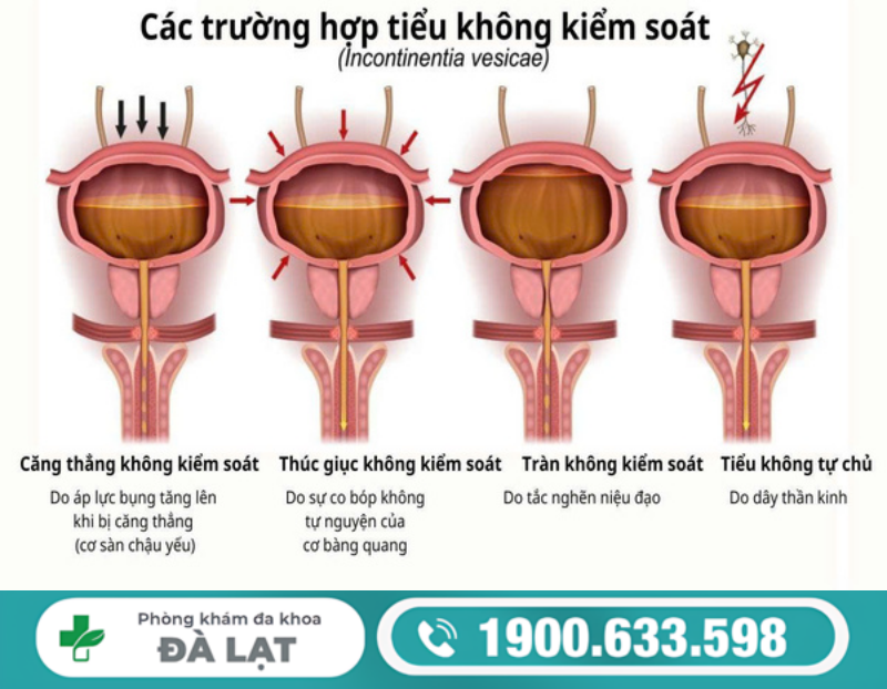 NAM GIỚI ĐI TIỂU KHÔNG KIỂM SOÁT LÀ BỆNH GÌ? NGUYÊN NHÂN VÀ CÁCH ĐIỀU TRỊ 