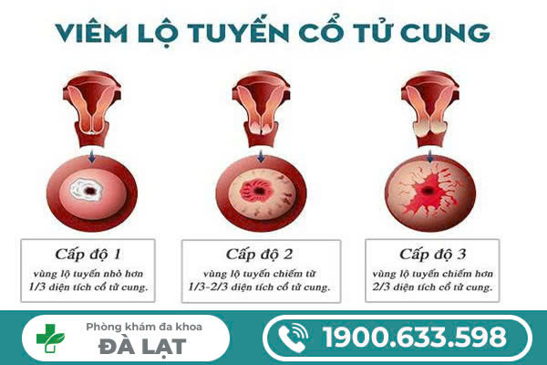 Hình Ảnh Viêm Lộ Tuyến Cổ Tử Cung Qua Từng Cấp Độ 