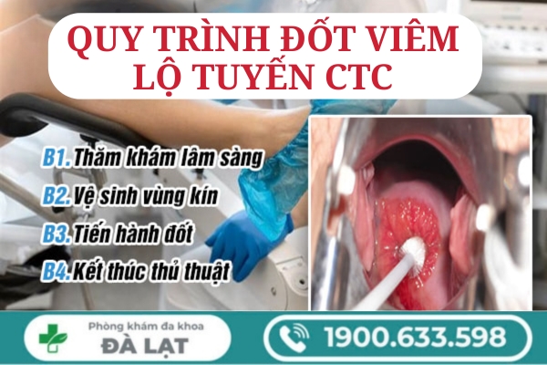Bác Sĩ Tư Vấn Đốt Viêm Lộ Tuyến Cổ Tử Cung 