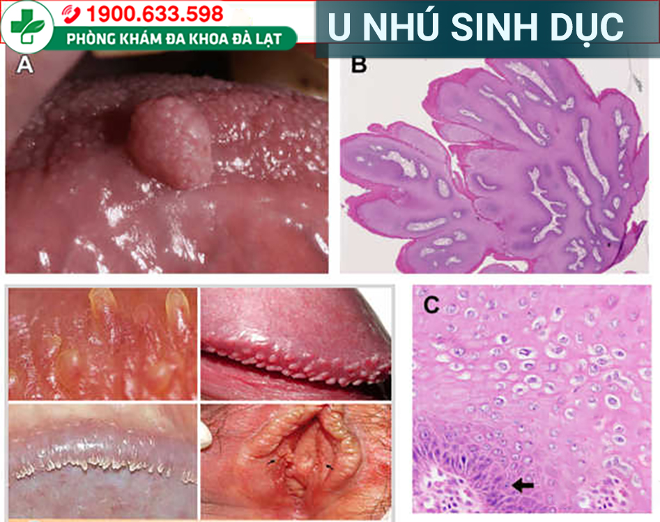 U Nhú Âm Hộ: Nguyên Nhân Và Cách Khắc Phục 