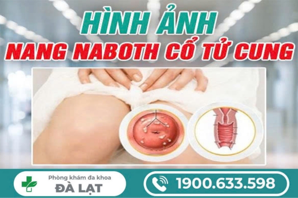 Chia Sẻ Hình Ảnh Nang Naboth Cổ Tử Cung 