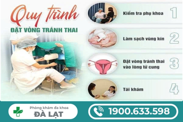 Tìm Hiểu: Cách Đặt Vòng Tránh Thai 