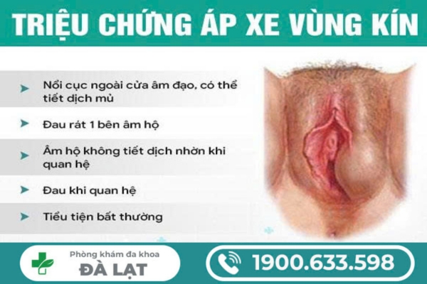 Áp Xe Vùng Kín Là Gì? Dấu Hiệu, Biến Chứng và Cách Điều Trị 