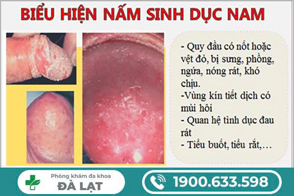CÁC TRIỆU CHỨNG CẢNH BÁO NẤM SINH DỤC Ở NAM GIỚI 