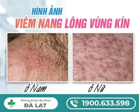 Hình Ảnh Viêm Nang Lông Vùng Kín 