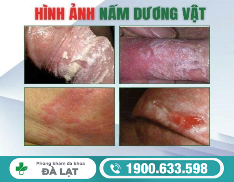 HÌNH ẢNH NẤM BAO QUY ĐẦU CẢNH BÁO VIÊM NHIỄM NAM KHOA NGUY HIỂM 