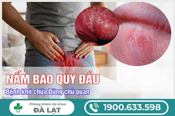 BỆNH NẤM BAO QUY ĐẦU ẢNH HƯỞNG NGUY HIỂM TỚI SINH SẢN NAM GIỚI 