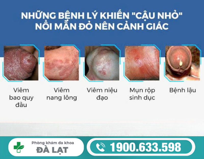 ĐẦU KHẤC BỊ MẨN ĐỎ Ở NAM GIỚI: NGUYÊN NHÂN THƯỜNG GẶP VÀ CÁCH ĐIỀU TRỊ 