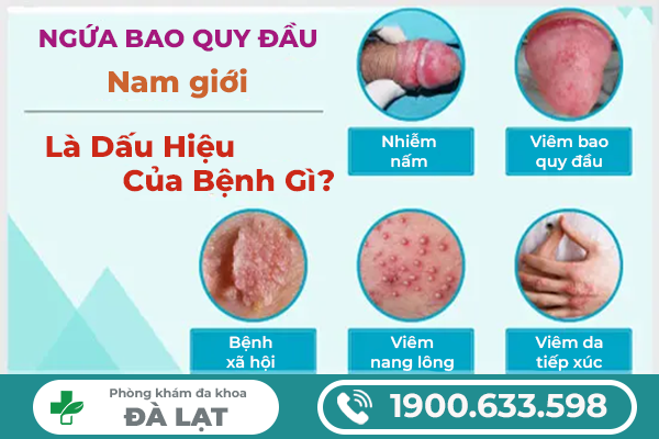 CÁCH CHỮA NGỨA DƯƠNG VẬT AN TOÀN, HIỆU QUẢ CHO NAM GIỚI