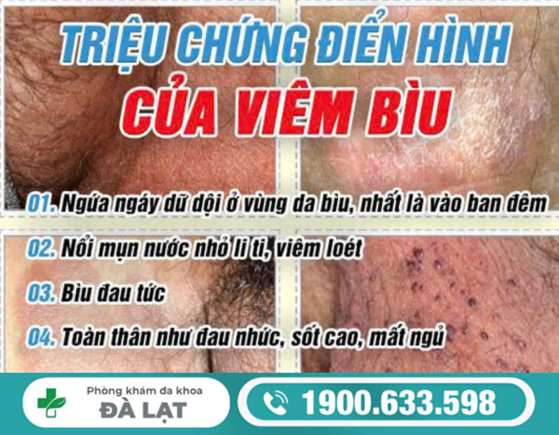 ĐAU BÌU MỘT BÊN LÀ DẤU HIỆU BỆNH GÌ Ở NAM GIỚI?