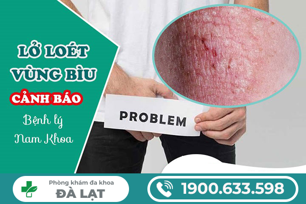 BỊ LỞ LOÉT Ở BÌU: BỆNH LÝ NAM KHOA THƯỜNG GẶP VÀ CÁCH ĐIỀU TRỊ 