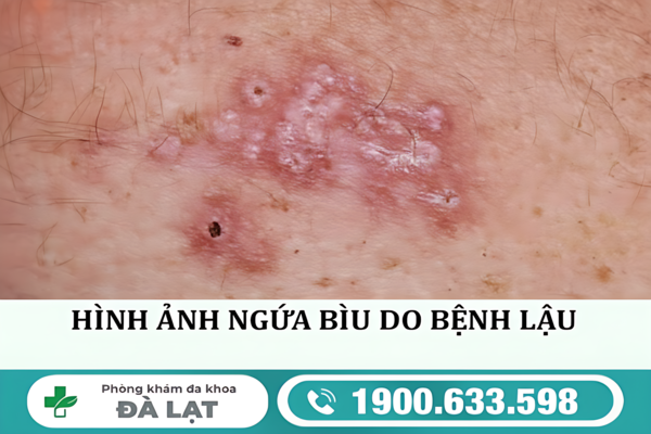 NGỨA BÌU DƯƠNG VẬT CẢNH BÁO BỆNH LÝ NAM KHOA NGUY HIỂM 