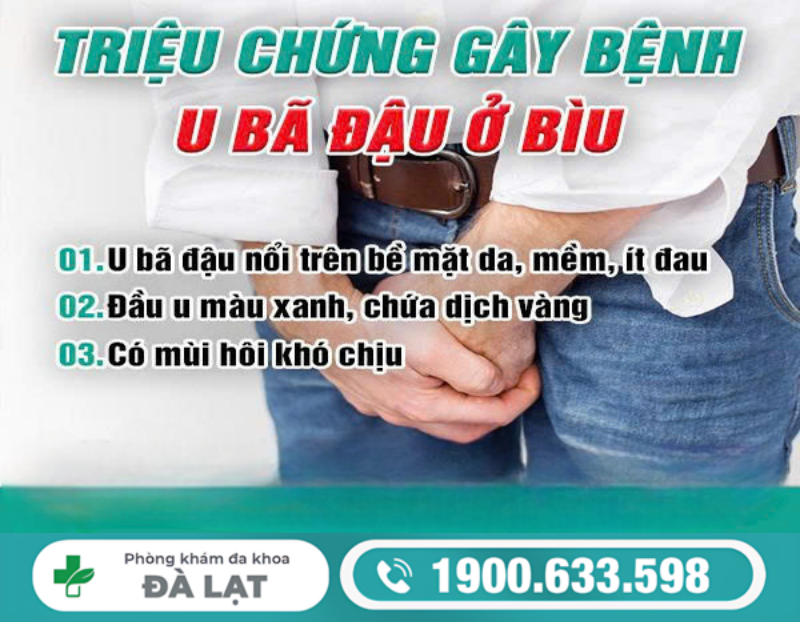 NAM GIỚI BỊ U BÃ ĐẬU Ở BÌU: DẤU HIỆU NHẬN BIẾT VÀ MỨC ĐỘ NGUY HIỂM 