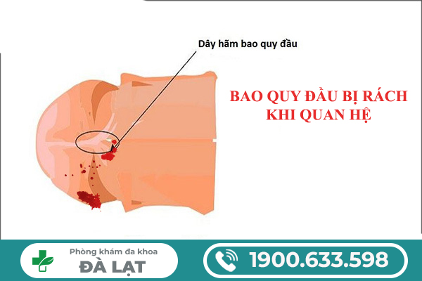 RÁCH BAO QUY ĐẦU CÓ ẢNH HƯỞNG ĐẾN SINH LÝ NAM GIỚI KHÔNG?