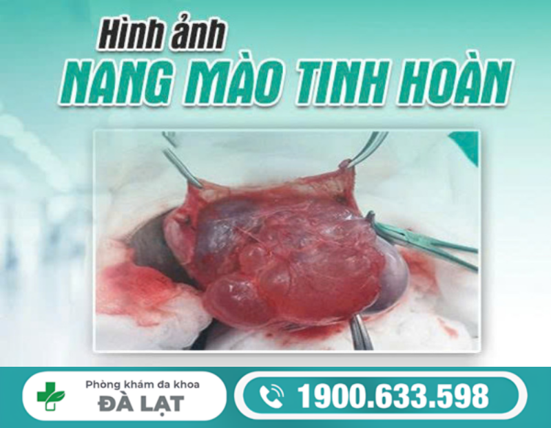 HÌNH ẢNH NANG MÀO TINH HOÀN VÀ CÁCH NHẬN BIẾT SỚM