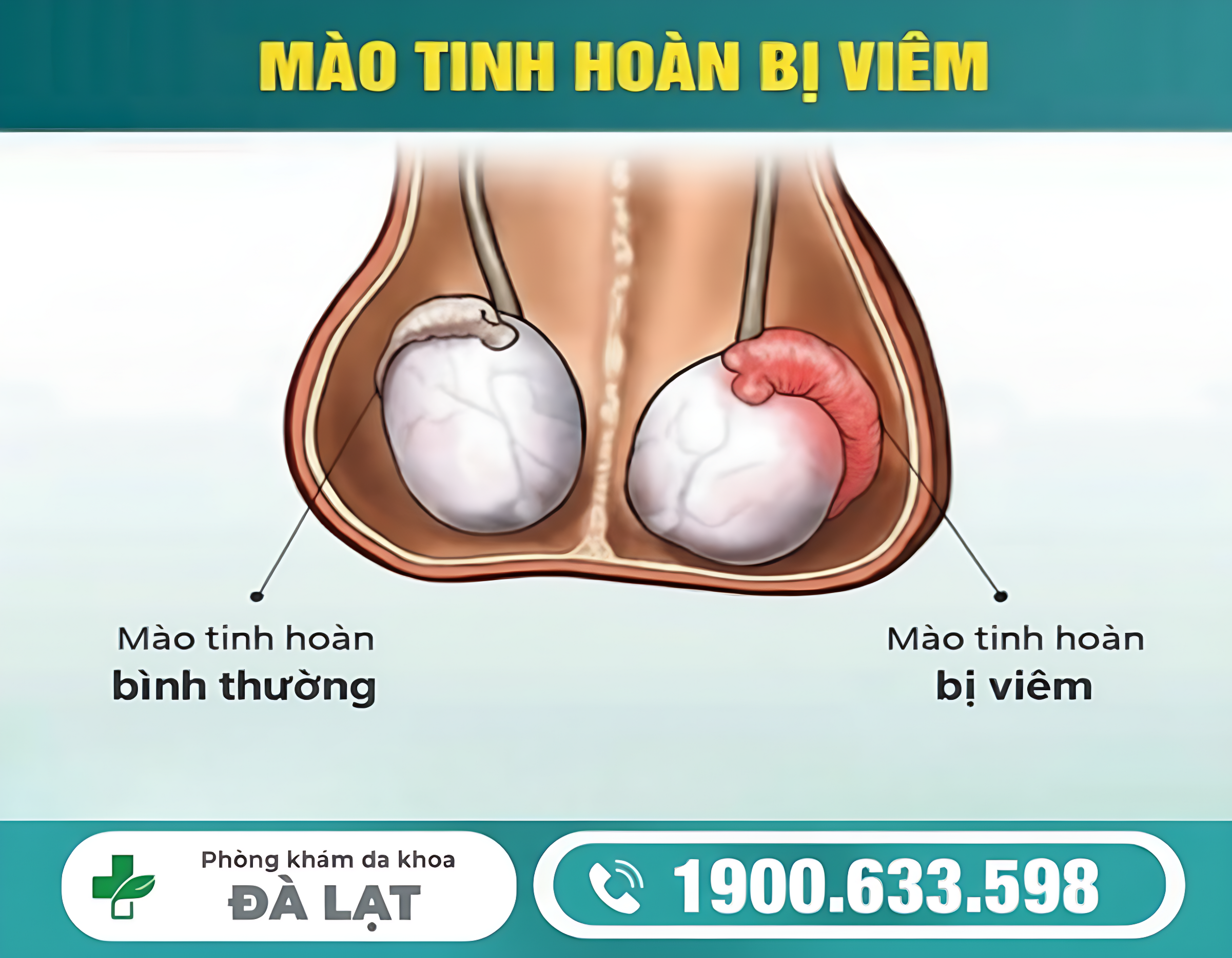 NHẬN BIẾT SỚM NANG MÀO TINH HOÀN BÊN PHẢI Ở NAM GIỚI 