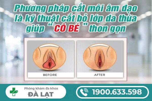 Tìm Hiểu Về: Cắt Môi Âm Đạo 