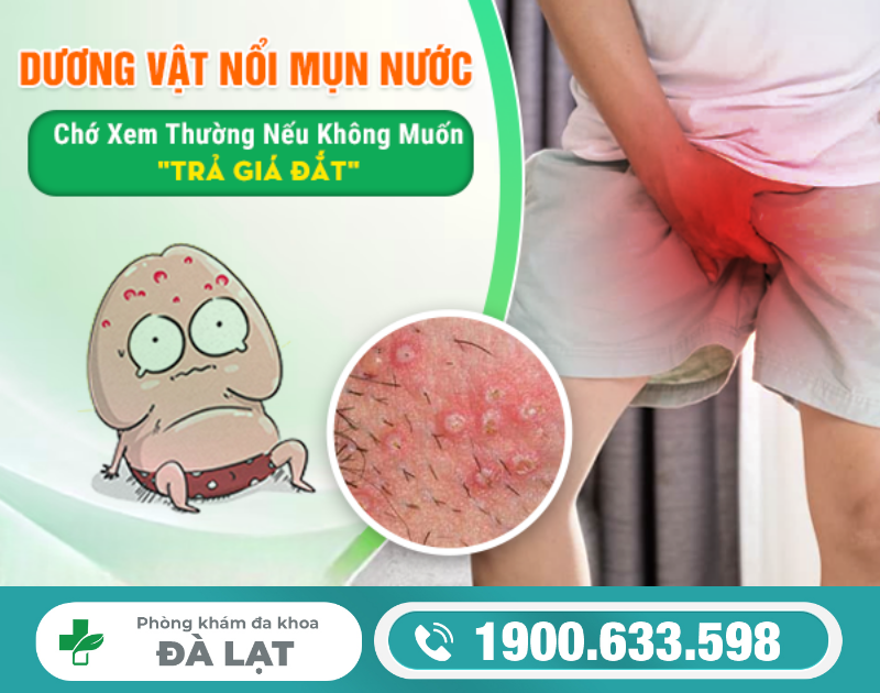 Dương Vật Bị Nổi Mụn Nước 