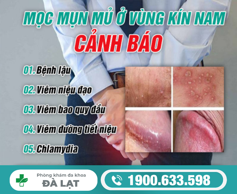 Dương Vật Nổi Mụn Mủ 