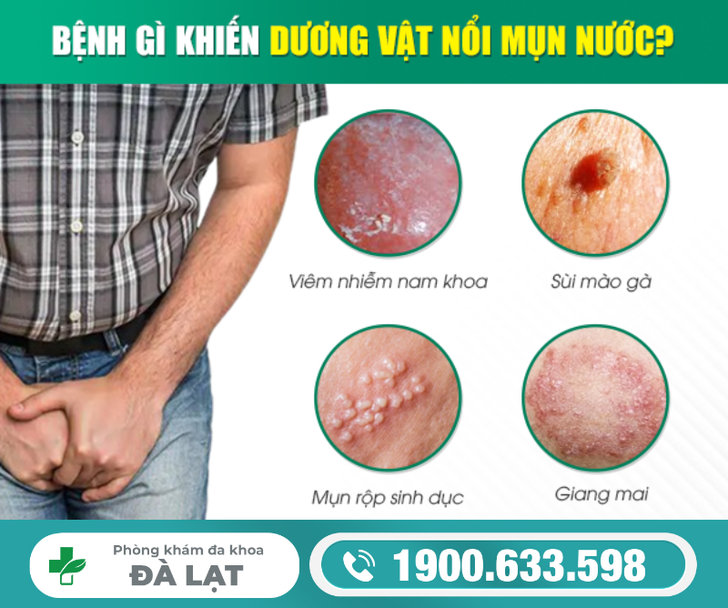 Mụn Nước Ở Bao Quy Đầu Cảnh Báo Bệnh Gì? 