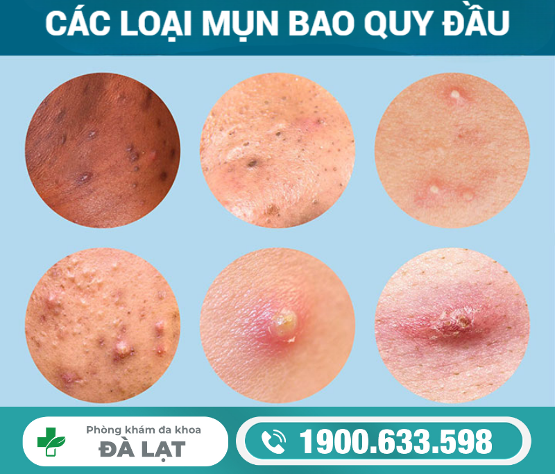 Nhận Biết: Mụn Ở Rãnh Quy Đầu 