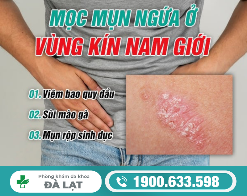 Mụn Ngứa Ở Bao Quy Đầu Nam Giới 