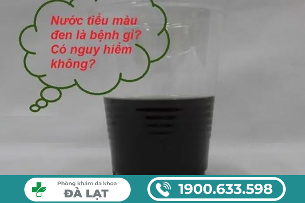 NƯỚC TIỂU MÀU NÂU ĐEN Ở NAM GIỚI LÀ DẤU HIỆU BỆNH GÌ?