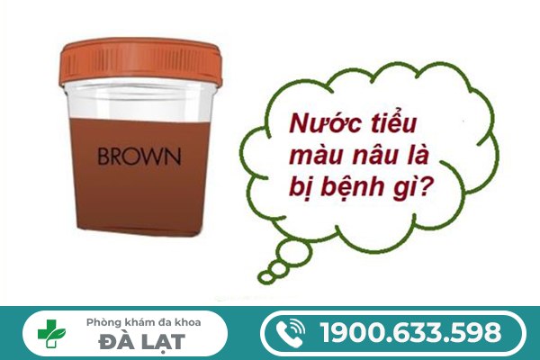 NƯỚC TIỂU MÀU NÂU Ở NAM VÀ NỮ CẢNH BÁO BỆNH LÝ GÌ?