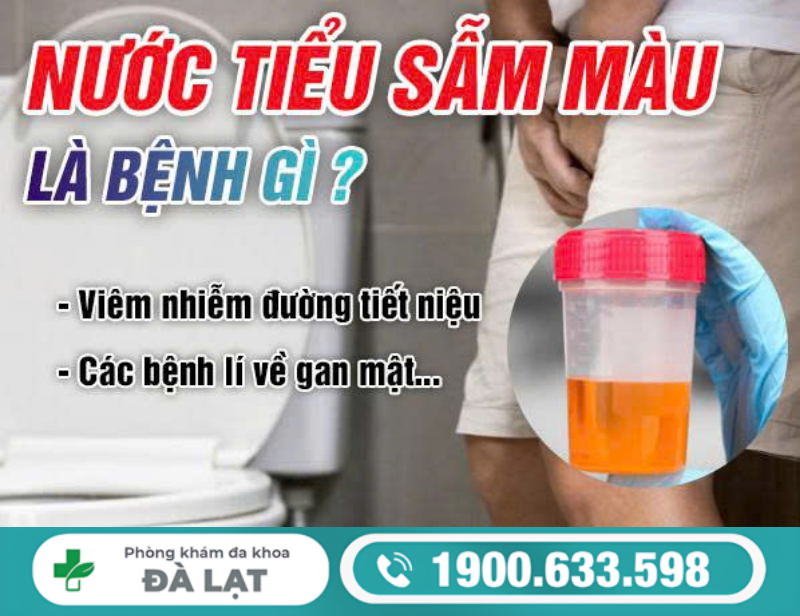 NƯỚC TIỂU SẪM MÀU Ở NAM VÀ NỮ LÀ DẤU HIỆU BỆNH LÝ NGUY HIỂM GÌ?