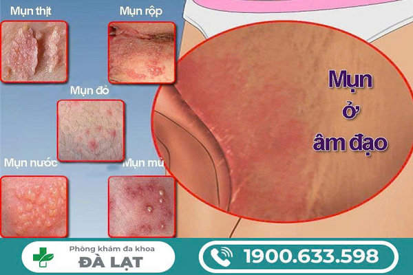 Mọc Mụn Trong Âm Đạo Nữ Giới