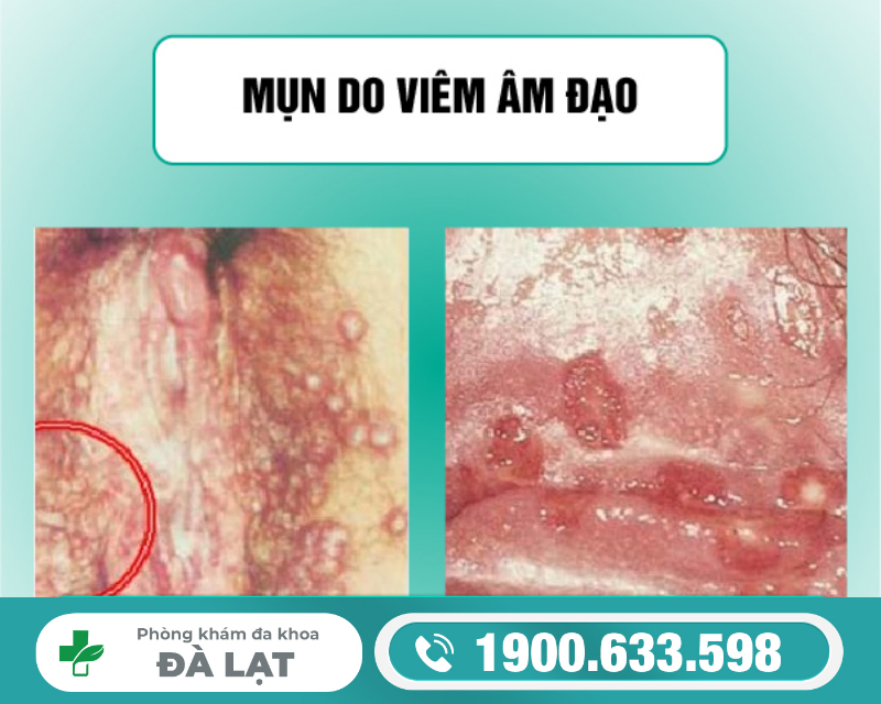 Mụn Do Viêm Âm Đạo Ở Nữ Giới 