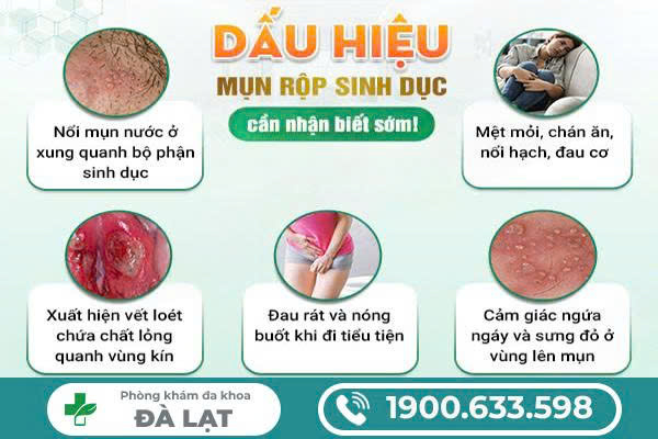 Cách Nhận Biết Mụn Rộp Sinh Dục 