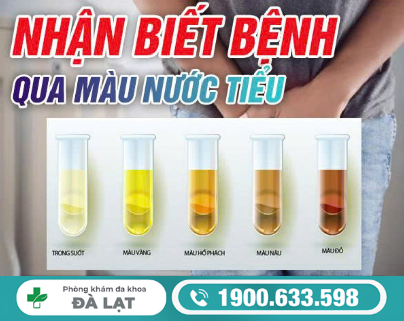 NHẬN BIẾT BỆNH QUA MÀU NƯỚC TIỂU Ở NAM VÀ NỮ 